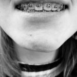 Traveling with kids who have orthodontic braces