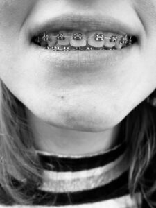 Traveling with kids who have orthodontic braces